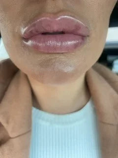 Difference between a vascular occlusion and bruising from dermal filler?