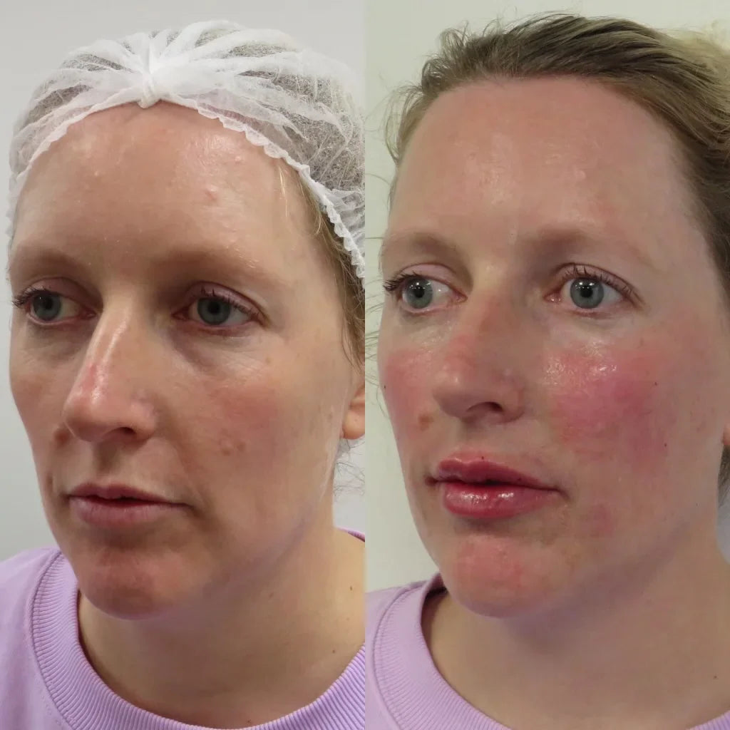 1ml lip filler before and after: My experience