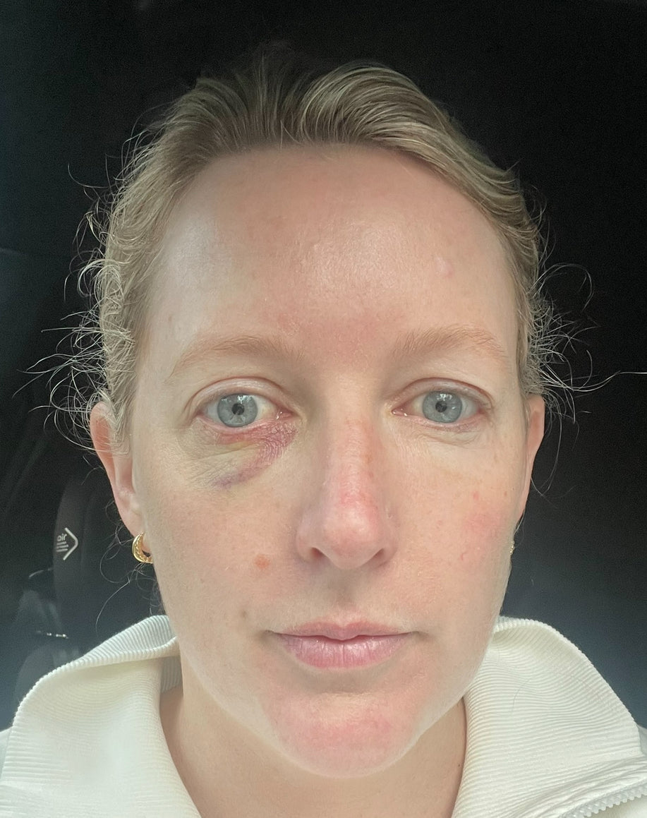 What to do for under eye bruising