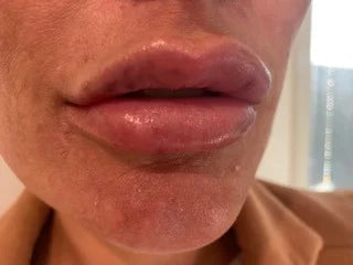 Lip filler bruising stages